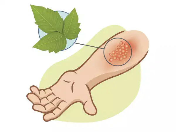 مكونات طبيعية لعلاج حساسية الجلد