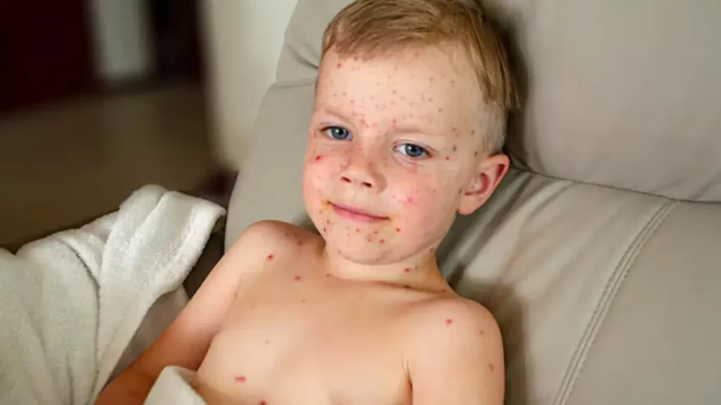 طفل مصاب بالطفح الجلدي للحصبة