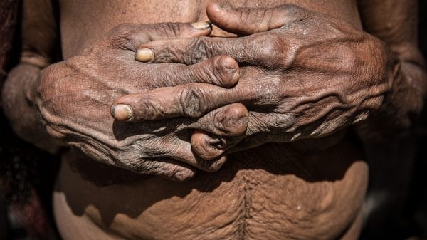 يد سيدة من قبيلة داني تظهر آثار بتر الأصابع