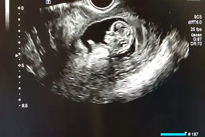 معرفة جنس الجنين قبل السونار